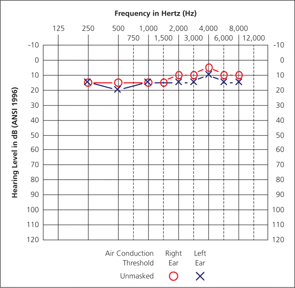 Ear Pathologies and Audiograms: Part 1 (Frequent Offenders) – TJ ...