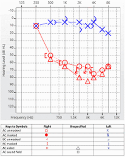 Ear Pathologies and Audiograms Part 6: Sudden Sensorineural Hearing ...